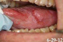 SIDE OF TONGUE WHITE AND EROSIVE LESION CANCER RISK