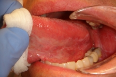 WHITE TONGUE LESIONS ARE BIOPSIED IN THIS CASE IT WAS BENIGN MIGRATORY MUCOSITIS