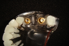 1. 3 TEETH REPLACED BY TWO IMPLANTS