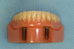 TWO LOWER IMPLANTS TO SUPPORT A DENTURE. Ths is the simplest way to restore  all  the lower missing teeth.