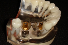 2. CROWNS NOT ON ABUTMENTS YET