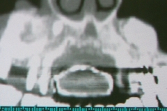 2. CT SCAN SHOWS SCOOPED OUT DEFECT 2
