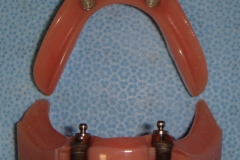 2 implants with special attachments that fit into the denture for stability.