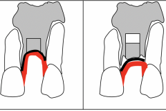 2. SANDWICH GRAFT to INCREASE VERTICAL
