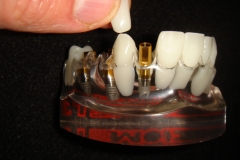CROWN white ABUTMENT connection IMPLANT Grey