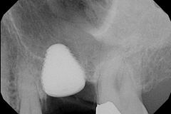 WIDE BODY IMPLANT TO REPLACE A MOLAR IMMEDIATELY