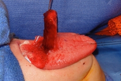 The tongue flap is being developed. It derives its blood supply from the front part of the tongue.