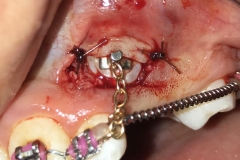EXPOSURE OF IMPACTED CANINES