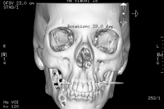JAW SURGERY ORTHOGNATHIC SURGERY CT3D