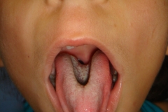 Unsuaul CLeft Tongue