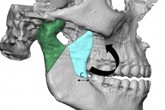 5. SURGICAL PLAN TO REMOVE TUMOR green and REPLACE WITH LOWER JAW GRAFT blue